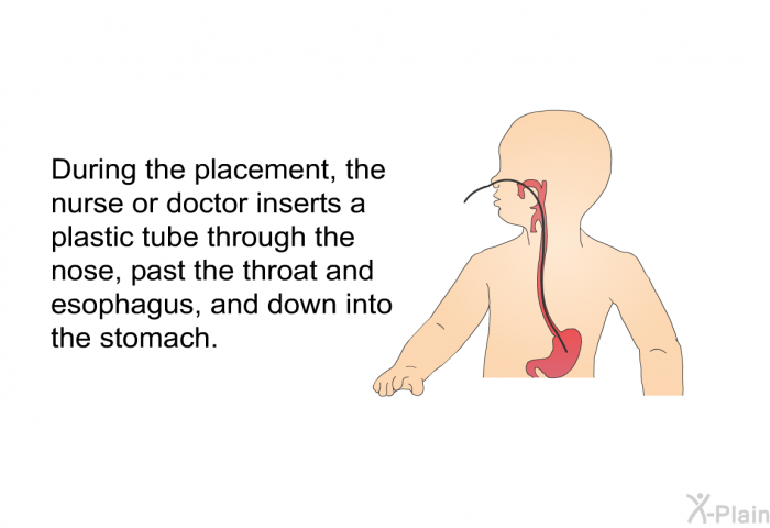 During the placement, the nurse or doctor inserts a plastic tube through the nose, past the throat and esophagus, and down into the stomach.