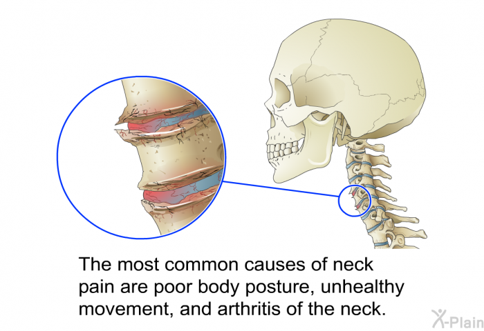 The most common causes of neck pain are poor body posture, unhealthy movement, and arthritis of the neck.
