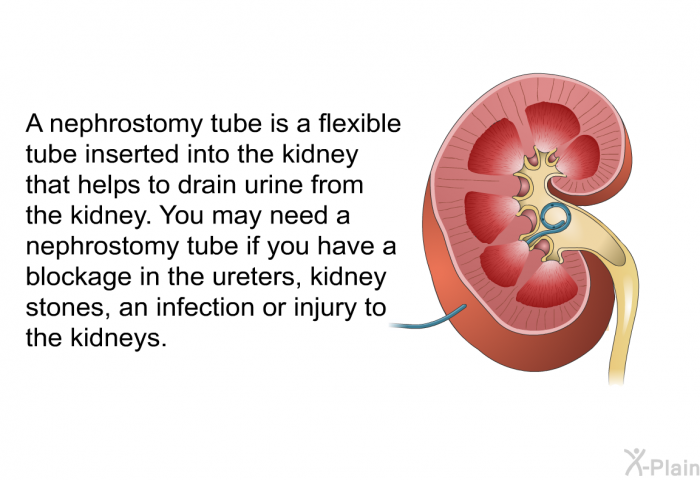 A nephrostomy tube is a flexible tube inserted into the kidney that helps to drain urine from the kidney. You may need a nephrostomy tube if you have a blockage in the ureters, kidney stones, an infection or injury to the kidneys.