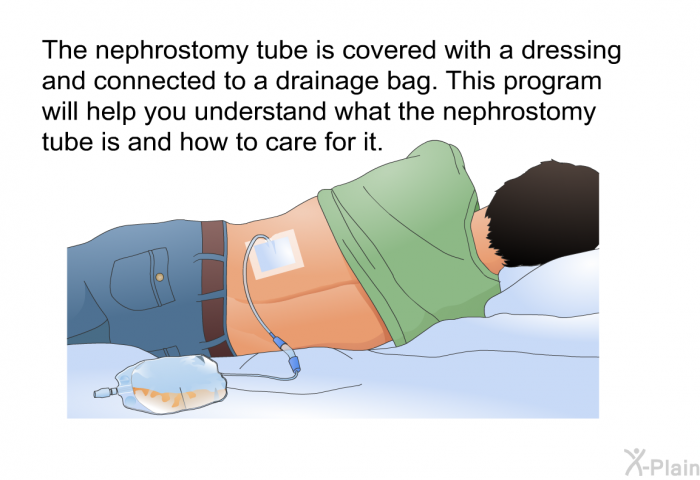 The nephrostomy tube is covered with a dressing and connected to a drainage bag. This health information will help you understand what the nephrostomy tube is and how to care for it.