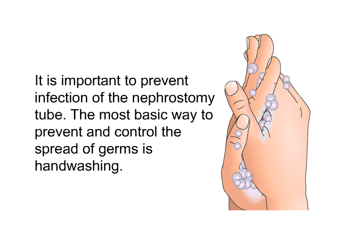 It is important to prevent infection of the nephrostomy tube. The most basic way to prevent and control the spread of germs is handwashing.