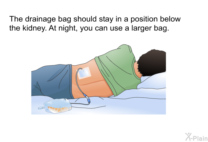 The drainage bag should stay in a position below the kidney. At night, you can use a larger bag.