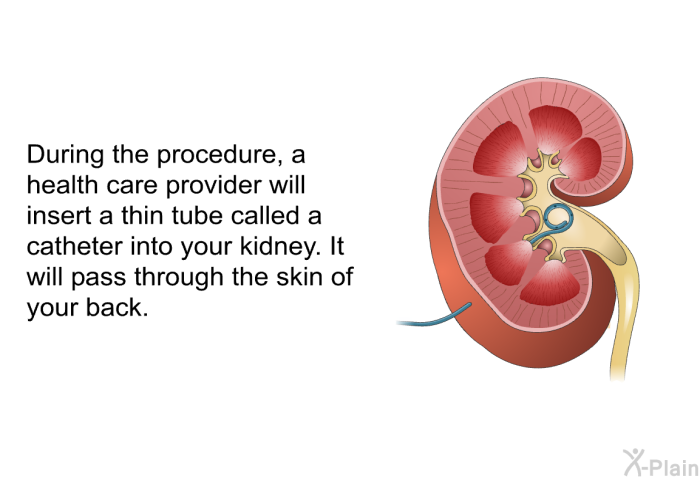 During the procedure, a health care provider will insert a thin tube called a catheter into your kidney. It will pass through the skin of your back.