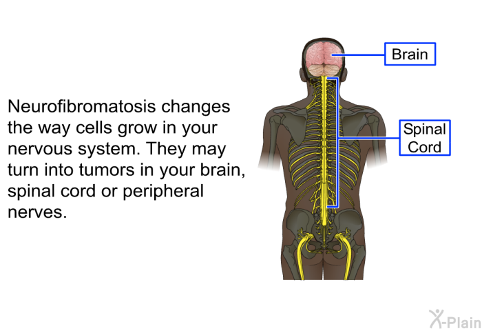 Neurofibromatosis changes the way cells grow in your nervous system. They may turn into tumors in your brain, spinal cord or peripheral nerves.