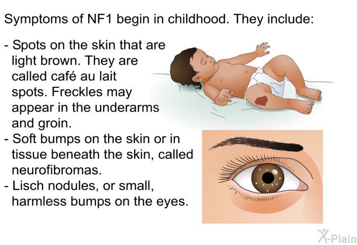 Symptoms of NF1 begin in childhood. They include:  Spots on the skin that are light brown. They are called caf au lait spots. Freckles may appear in the underarms and groin. Soft bumps on the skin or in tissue beneath the skin, called neurofibromas. Lisch nodules, or small, harmless bumps on the eyes.