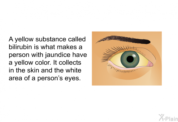 A yellow substance called bilirubin is what makes a person with jaundice have a yellow color. It collects in the skin and the white area of a person's eyes.