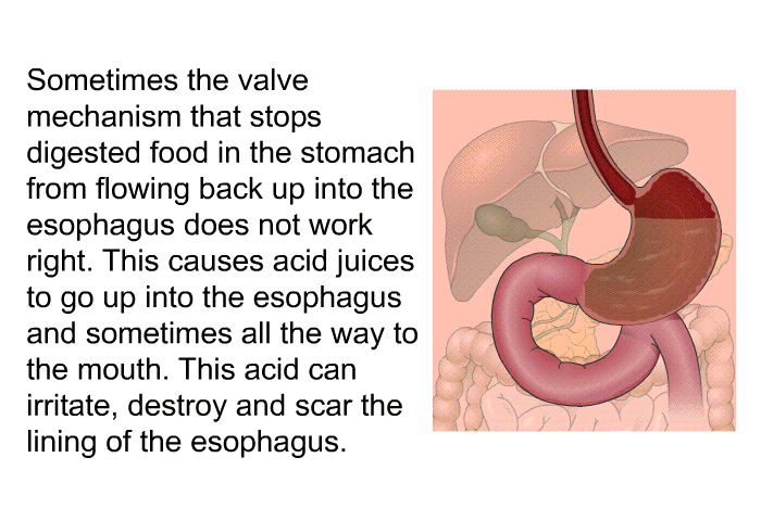 Sometimes the valve mechanism that stops digested food in the stomach from flowing back up into the esophagus does not work right. This causes acid juices to go up into the esophagus and sometimes all the way to the mouth. This acid can irritate, destroy and scar the lining of the esophagus.