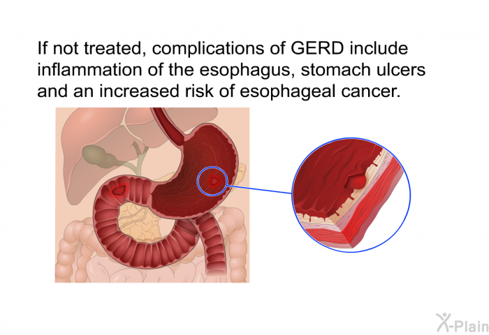 If not treated, complications of GERD include inflammation of the esophagus, stomach ulcers and an increased risk of esophageal cancer.