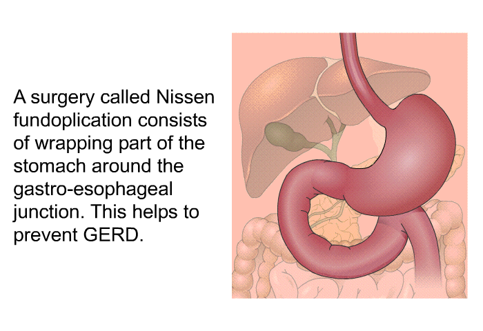 A surgery called Nissen fundoplication consists of wrapping part of the stomach around the gastro-esophageal junction. This helps to prevent GERD.