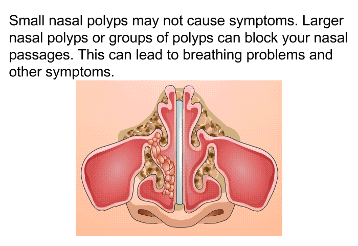 Small nasal polyps may not cause symptoms. Larger nasal polyps or groups of polyps can block your nasal passages. This can lead to breathing problems and other symptoms.