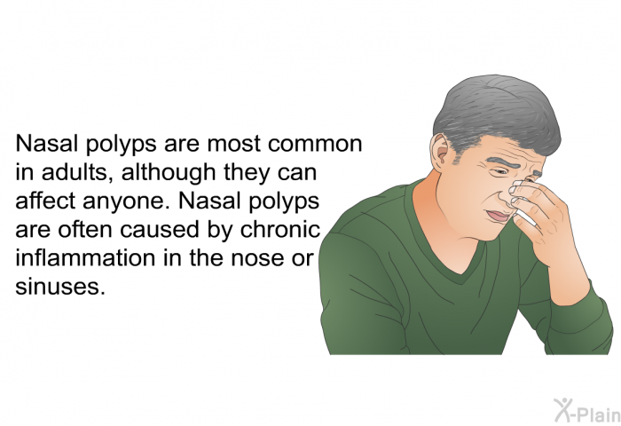 Nasal polyps are most common in adults, although they can affect anyone. Nasal polyps are often caused by chronic inflammation in the nose or sinuses.
