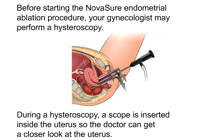 Before starting the NovaSure endometrial ablation procedure, your gynecologist may perform a hysteroscopy. During a hysteroscopy, a scope is inserted inside the uterus so the doctor can get a closer look at the uterus.