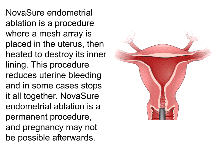 NovaSure endometrial ablation is a procedure where a mesh array is placed in the uterus, then heated to destroy its inner lining. This procedure reduces uterine bleeding and in some cases stops it all together. NovaSure endometrial ablation is a permanent procedure, and pregnancy may not be possible afterwards.