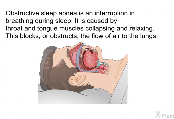 Obstructive sleep apnea is an interruption in breathing during sleep. It is caused by throat and tongue muscles collapsing and relaxing. This blocks, or <I>obstructs</I>, the flow of air to the lungs.