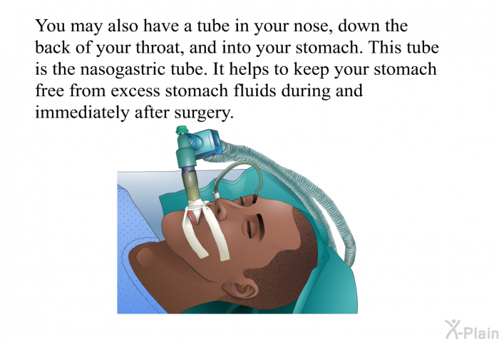You may also have a tube in your nose, down the back of your throat, and into your stomach. This tube is the nasogastric tube. It helps to keep your stomach free from excess stomach fluids during and immediately after surgery.