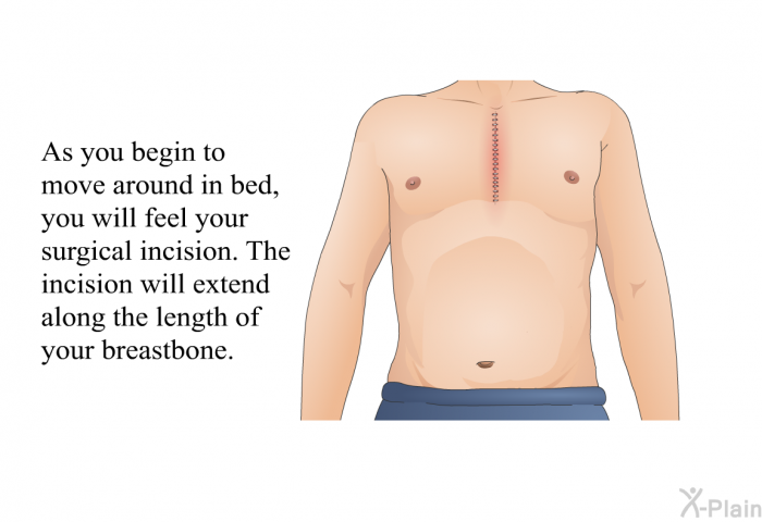 As you begin to move around in bed, you will feel your surgical incision. The incision will extend along the length of your breastbone.