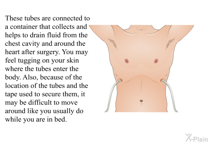 These tubes are connected to a container that collects and helps to drain fluid from the chest cavity and around the heart after surgery. You may feel tugging on your skin where the tubes enter the body. Also, because of the location of the tubes and the tape used to secure them, it may be difficult to move around like you usually do while you are in bed.