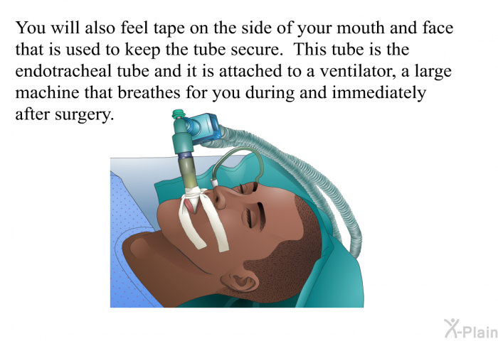 You will also feel tape on the side of your mouth and face that is used to keep the tube secure. This tube is the endotracheal tube and it is attached to a ventilator, a large machine that breathes for you during and immediately after surgery.