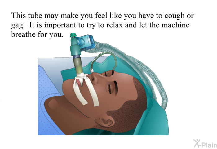 This tube may make you feel like you have to cough or gag. It is important to try to relax and let the machine breathe for you.