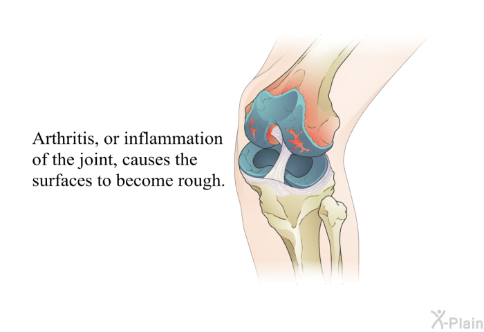 Arthritis, or inflammation of the joint, causes the surfaces to become rough.