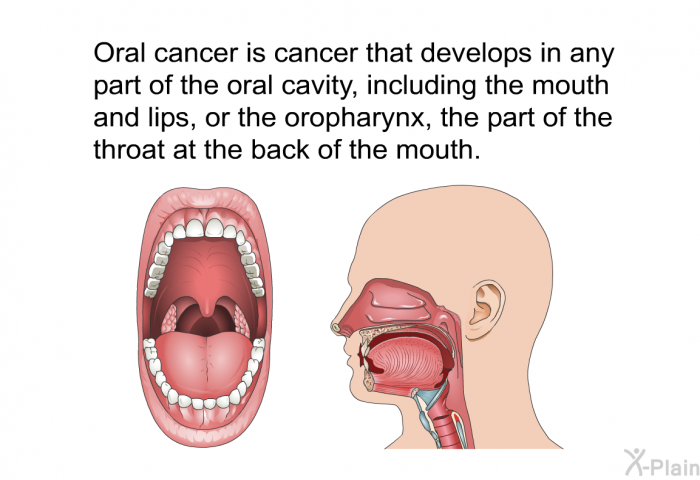 Oral cancer is cancer that develops in any part of the oral cavity, including the mouth and lips, or the oropharynx, the part of the throat at the back of the mouth.