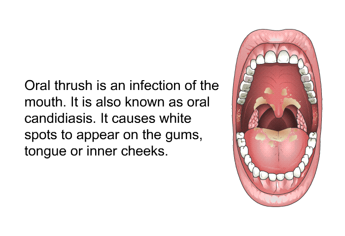 Oral thrush is an infection of the mouth. It is also known as oral candidiasis. It causes white spots to appear on the gums, tongue or inner cheeks.