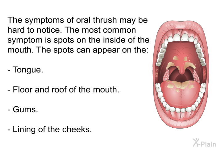 The symptoms of oral thrush may be hard to notice. The most common symptom is spots on the inside of the mouth. The spots can appear on the:  Tongue. Floor and roof of the mouth. Gums. Lining of the cheeks.