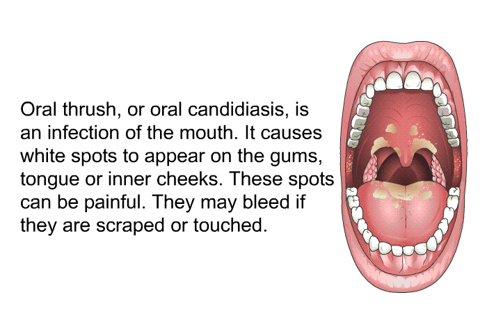 Oral thrush, or oral candidiasis, is an infection of the mouth. It causes white spots to appear on the gums, tongue or inner cheeks. These spots can be painful. They may bleed if they are scraped or touched.