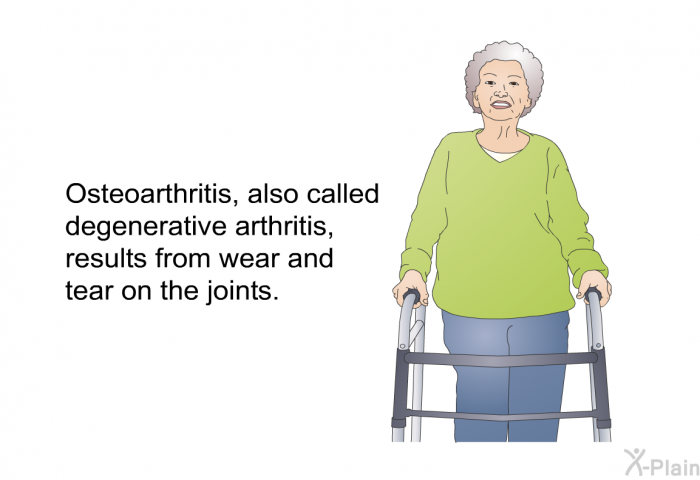 Osteoarthritis, also called degenerative arthritis<B>,</B> results from wear and tear on the joints.