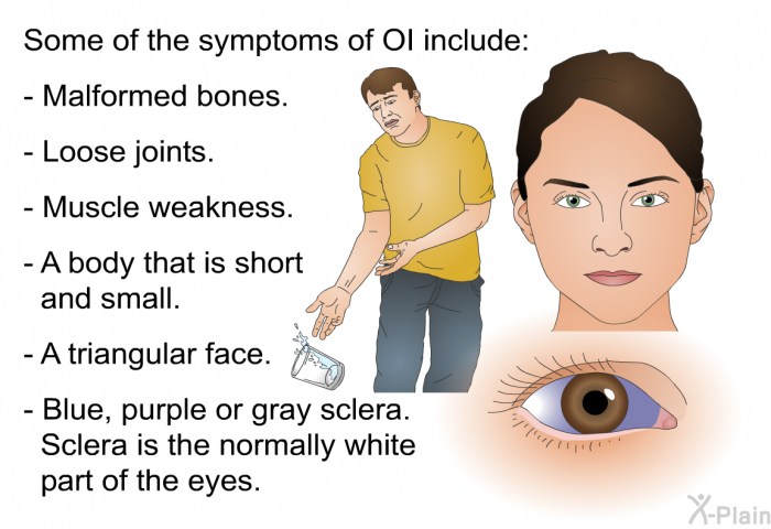 Some of the symptoms of OI include:  Malformed bones. Loose joints. Muscle weakness. A body that is short and small. A triangular face. Blue, purple or gray sclera. Sclera is the normally white part of the eyes.