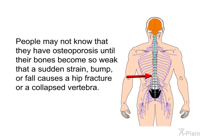 People may not know that they have osteoporosis until their bones become so weak that a sudden strain, bump, or fall causes a hip fracture or a collapsed vertebra.