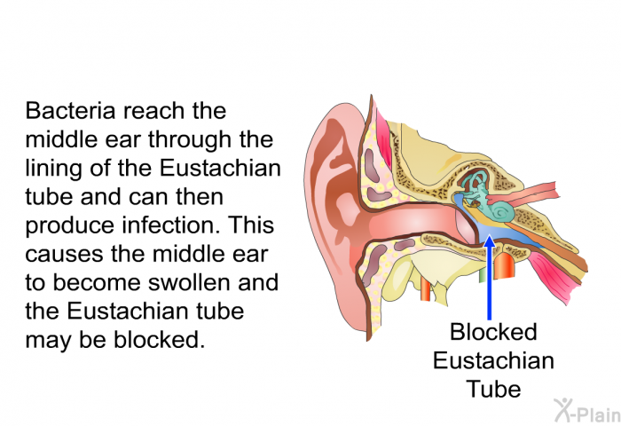 Bacteria reach the middle ear through the lining of the Eustachian tube and can then produce infection. This causes the middle ear to become swollen and the Eustachian tube may be blocked.