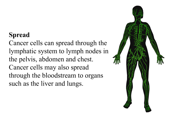 Spread - Cancer cells can spread through the lymphatic system to lymph nodes in the pelvis, abdomen and chest. Cancer cells may also spread through the bloodstream to organs such as the liver and lungs.