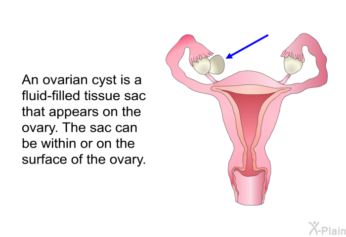 An ovarian cyst is a fluid-filled tissue sac that appears on the ovary. The sac can be within or on the surface of the ovary.