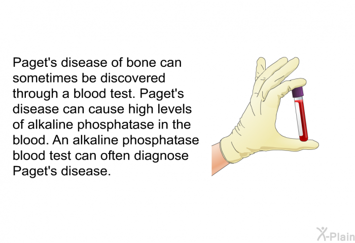 Paget's disease of bone can sometimes be discovered through a blood test. Paget's disease can cause high levels of alkaline phosphatase in the blood. An alkaline phosphatase blood test can often diagnose Paget's disease.
