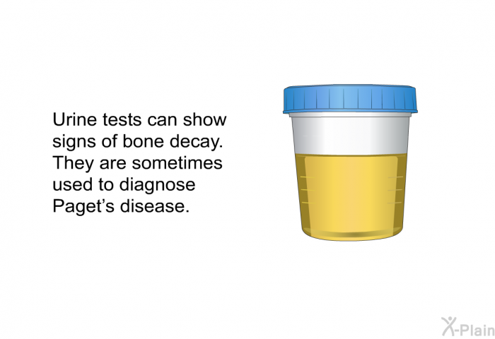 Urine tests can show signs of bone decay. They are sometimes used to diagnose Paget's disease.