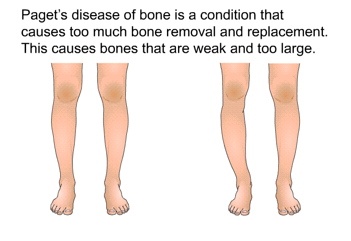 Paget's disease of bone is a condition that causes too much bone removal and replacement. This causes bones that are weak and too large.