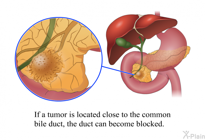 If a tumor is located close to the common bile duct, the duct can become blocked.