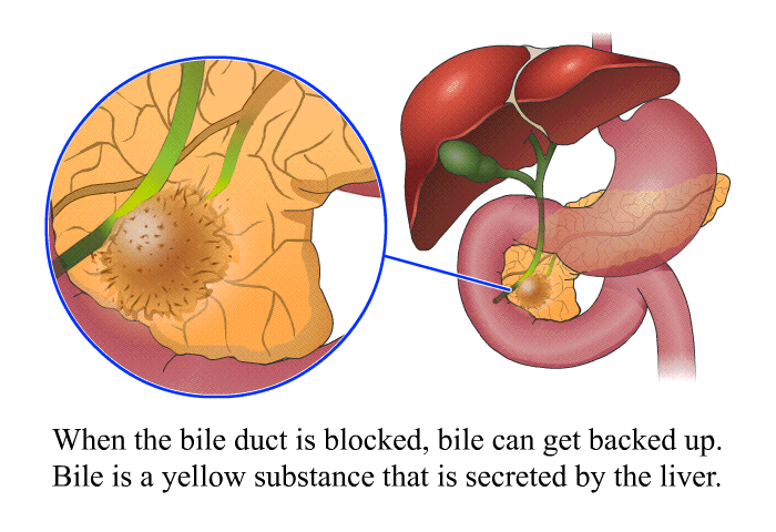 When the bile duct is blocked, bile can get backed up. Bile is a yellow substance that is secreted by the liver.