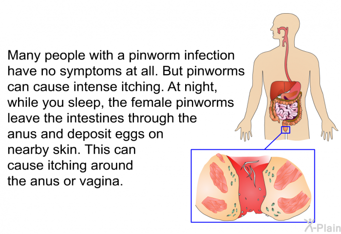 Many people with a pinworm infection have no symptoms at all. But pinworms can cause intense itching. At night, while you sleep, the female pinworms leave the intestines through the anus and deposit eggs on nearby skin. This can cause itching around the anus or vagina.