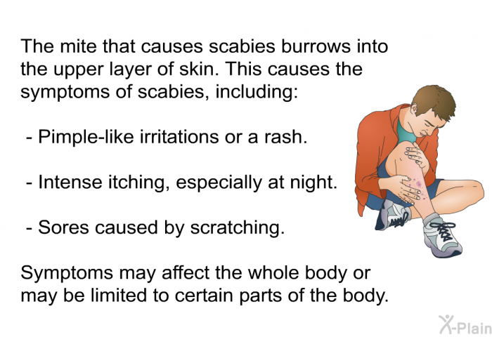 The mite that causes scabies burrows into the upper layer of skin. This causes the symptoms of scabies, including:  Pimple-like irritations or a rash. Intense itching, especially at night. Sores caused by scratching.  
Symptoms may affect the whole body or may be limited to certain parts of the body.