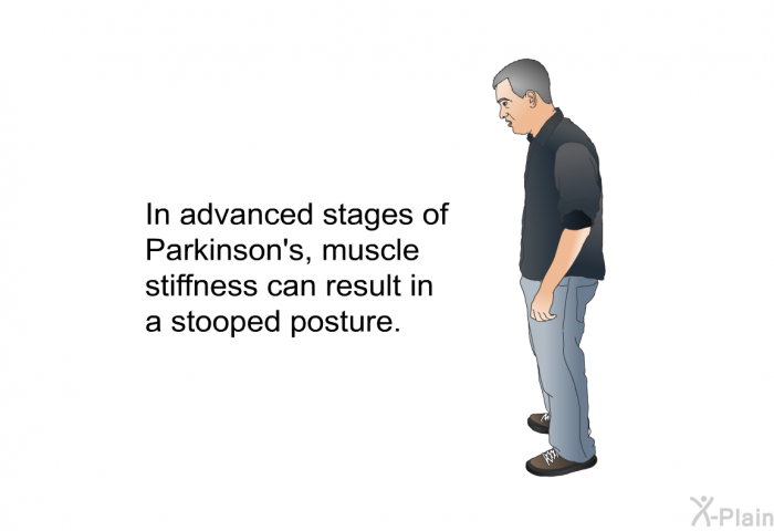 In advanced stages of Parkinson's, muscle stiffness can result in a stooped posture.