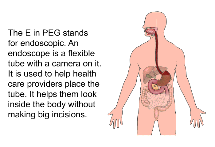 The E in PEG stands for endoscopic. An endoscope is a flexible tube with a camera on it. It is used to help health care providers place the tube. It helps them look inside the body without making big incisions.