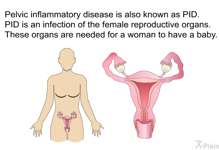Pelvic inflammatory disease is also known as PID. PID is an infection of the female reproductive organs. These organs are needed for a woman to have a baby.