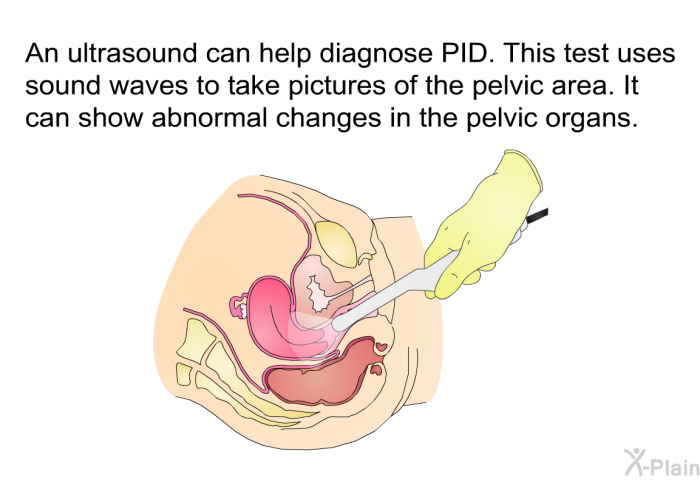 An ultrasound can help diagnose PID. This test uses sound waves to take pictures of the pelvic area. It can show abnormal changes in the pelvic organs.