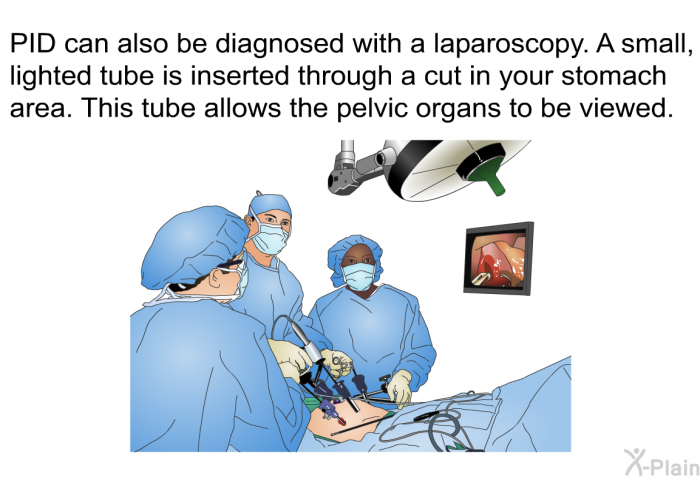 PID can also be diagnosed with a laparoscopy. A small, lighted tube is inserted through a cut in your stomach area. This tube allows the pelvic organs to be viewed.