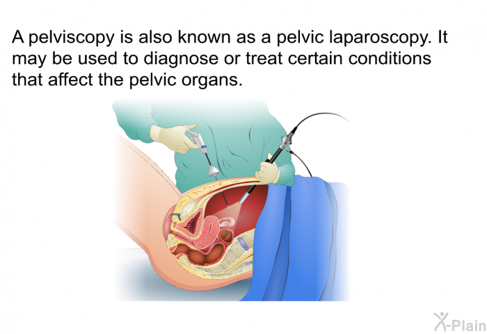 A pelviscopy is also known as a pelvic laparoscopy. It may be used to diagnose or treat certain conditions that affect the pelvic organs.