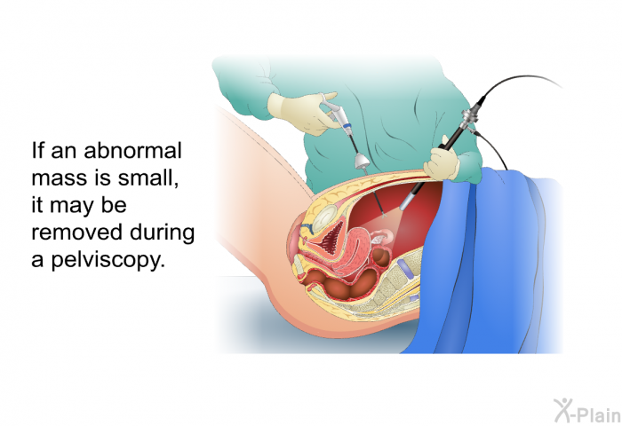 If an abnormal mass is small, it may be removed during a pelviscopy.
