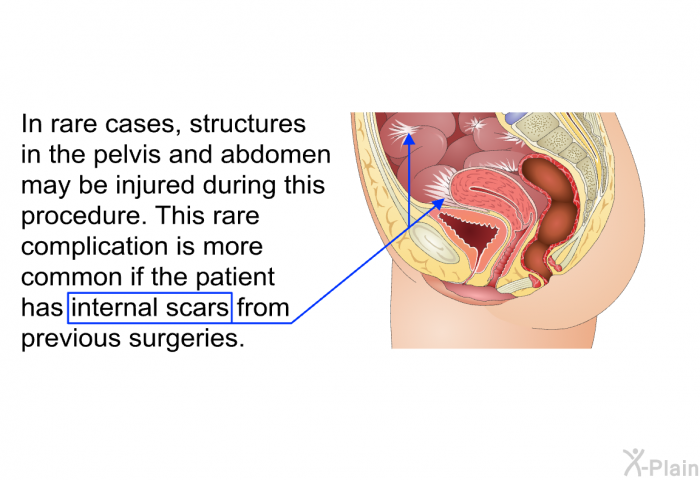 In rare cases, structures in the pelvis and abdomen may be injured during this procedure. This rare complication is more common if the patient has internal scars from previous surgeries.