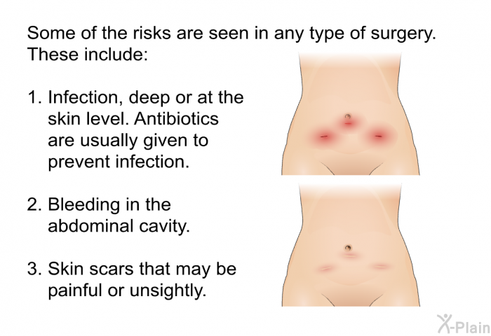 Some of the risks are seen in any type of surgery. These include:  Infection, deep or at the skin level. Antibiotics are usually given to prevent infection. Bleeding in the abdominal cavity. Skin scars that may be painful or unsightly.